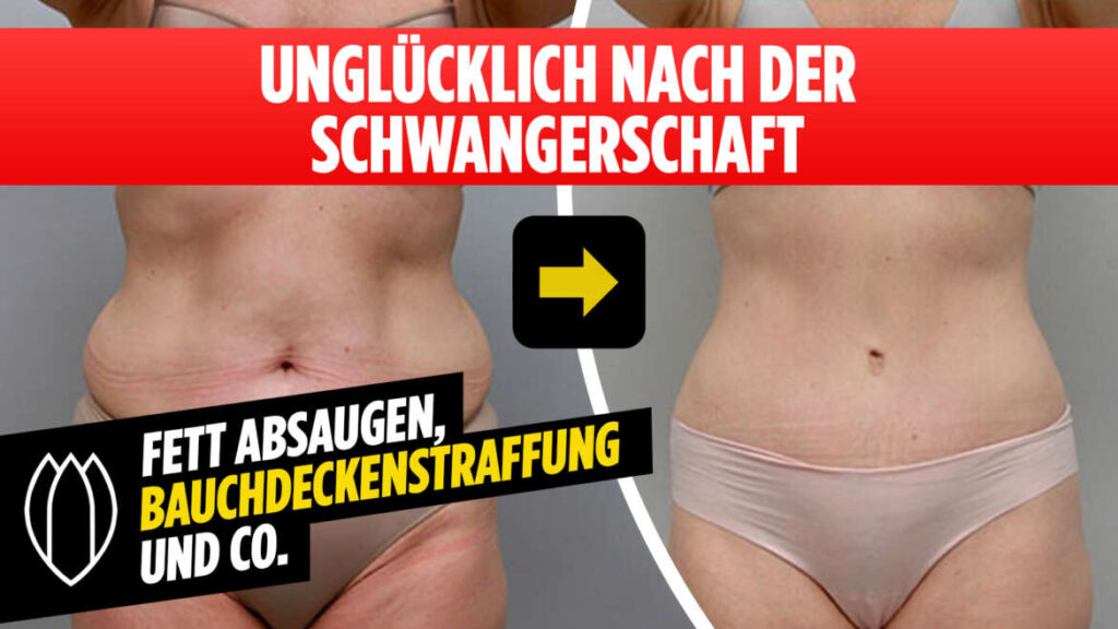 SCHÖNHEITS-OP NACH DER SCHWANGERSCHAFT