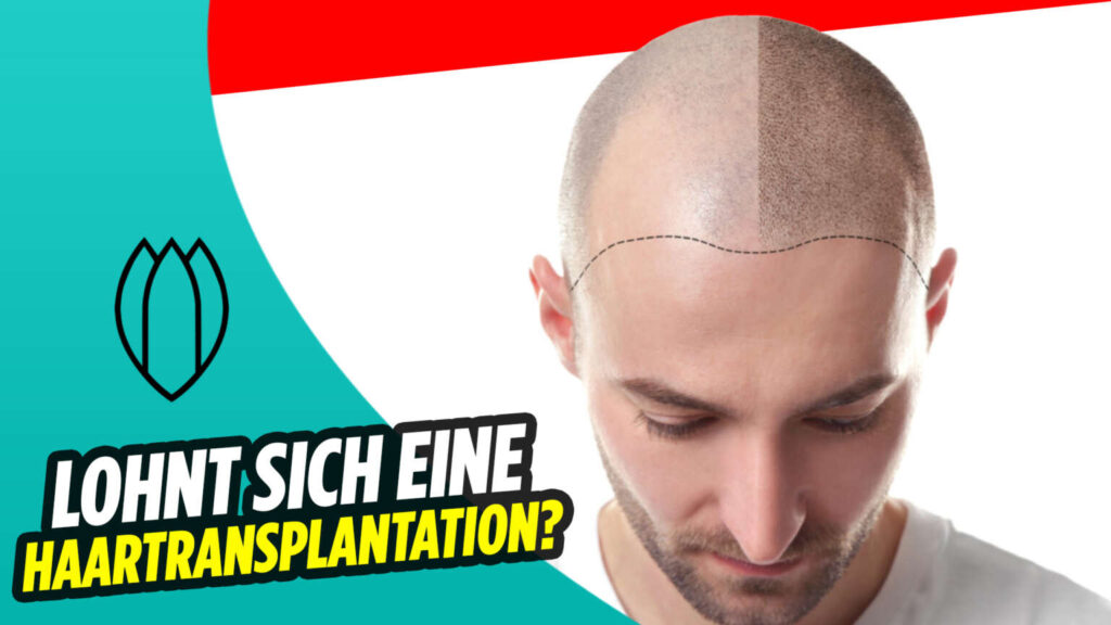 HAARTRANSPLANTATION – LOHNT SIE SICH?