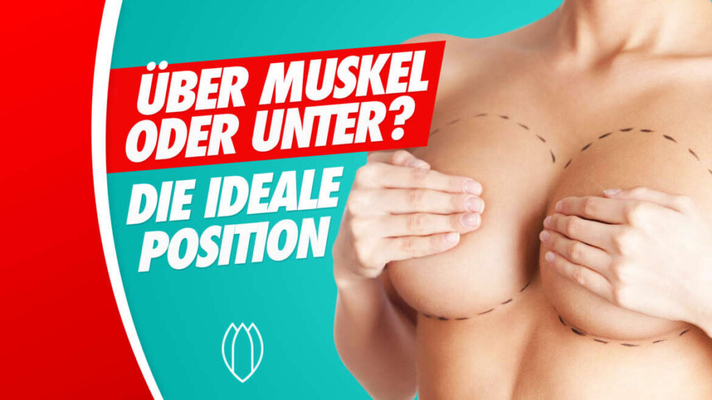ÜBER MUSKEL ODER UNTER MUSKEL, DIE IDEALE POSITIONIERUNG DER IMPLANTATE